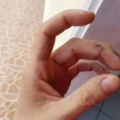 Toxicity of Silver Nitrate